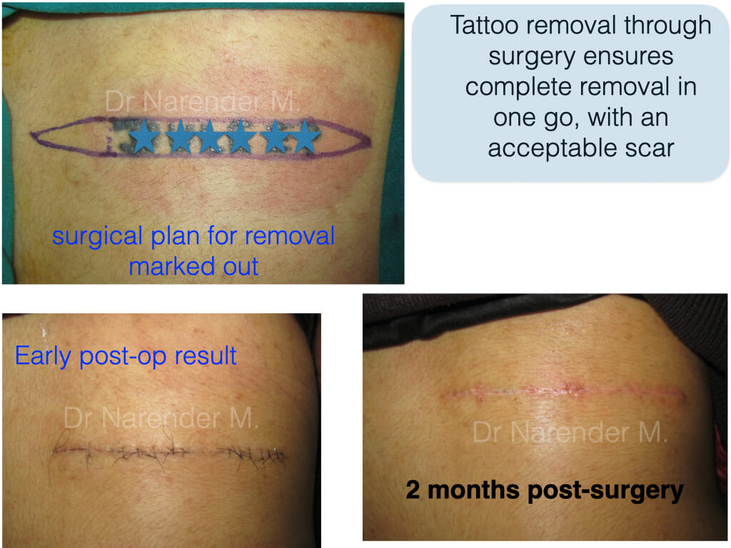 How Does Laser Tattoo Removal Work? | El Paso and Juarez